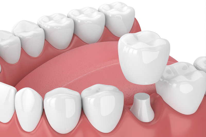 Dental Crowns in Carbondale