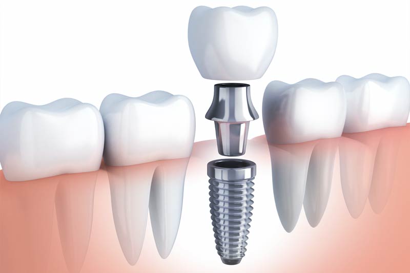 Implants Dentist in Carbondale