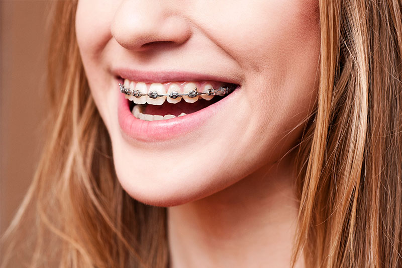 Orthodontics in Carbondale