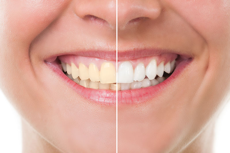 Teeth Whitening in Carbondale