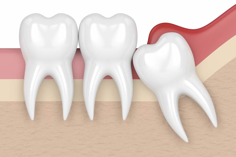 Wisdom Tooth Removal in Carbondale