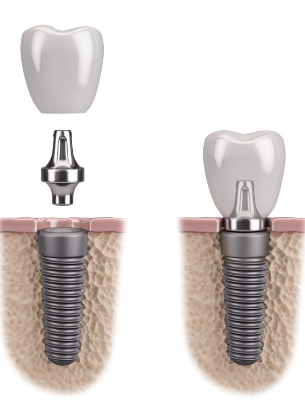 Tooth human implant