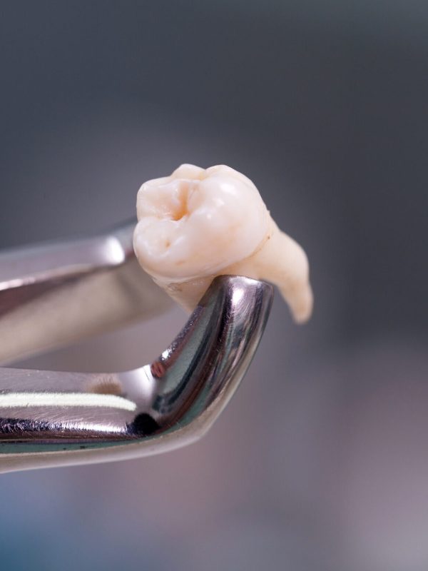 Dental equipment holding an extracted tooth