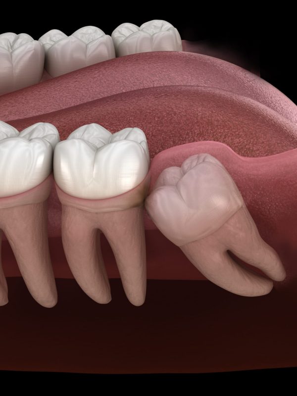 Healthy teeth and wisdom tooth with mesial impaction . Medically accurate tooth 3D illustration
