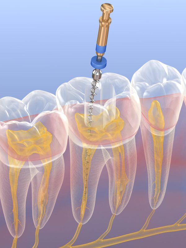 Endodontic root canal treatment process. Medically accurate tooth 3D illustration.