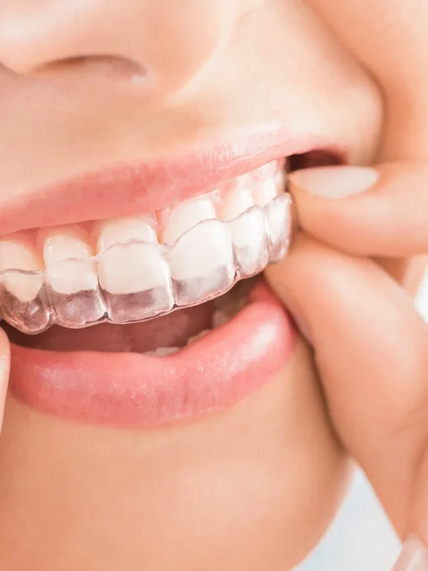 Woman wearing orthodontic silicone trainer. Invisible braces aligner. Mobile orthodontic appliance for dental correction.