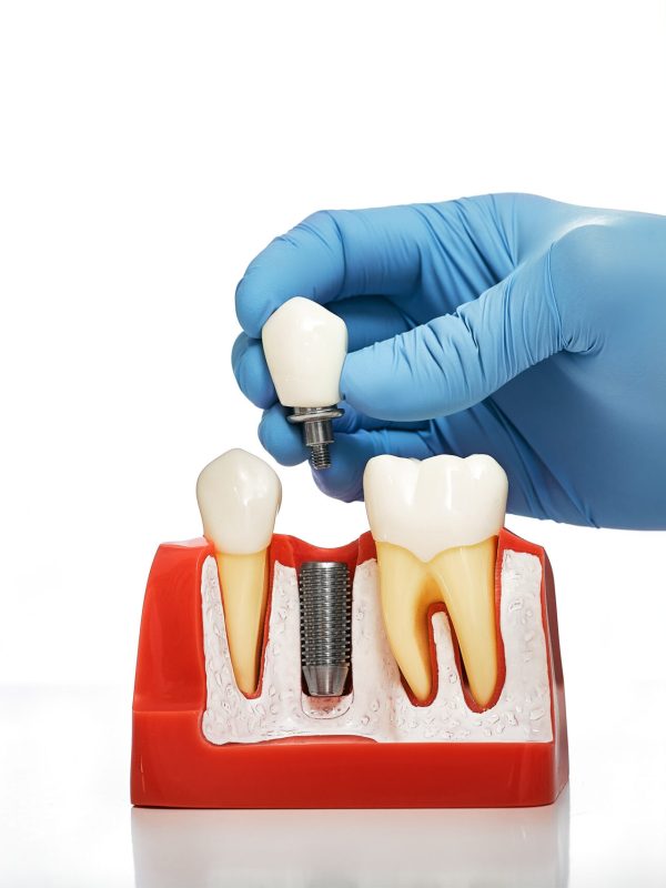 Dentist showing the installation of a dental implant on the anatomical model of teeth, close-up. Process of installing a dental implant