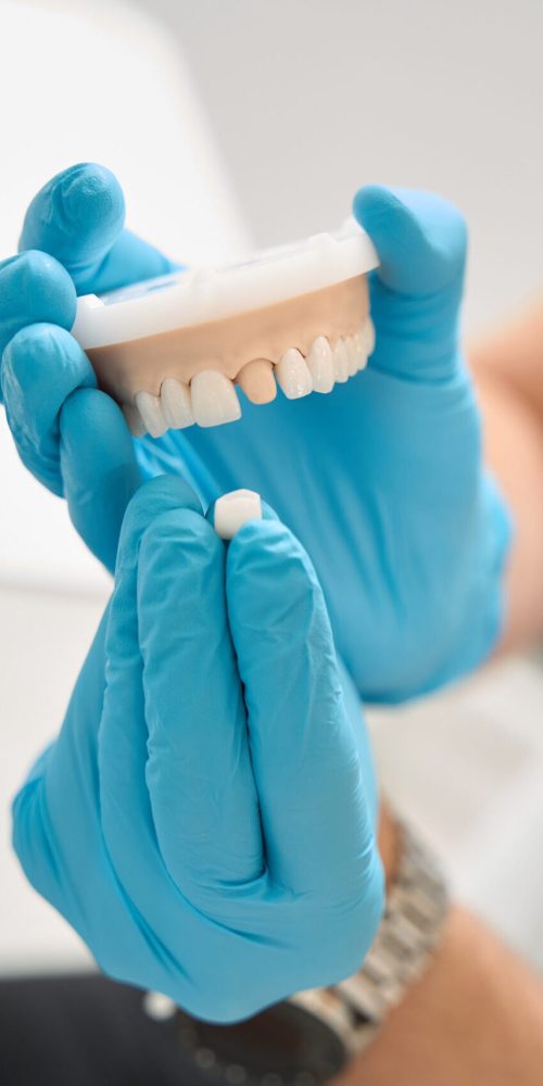 Cropped photo of dentist in disposable nitrile gloves holding dental crown and maxillary teeth model