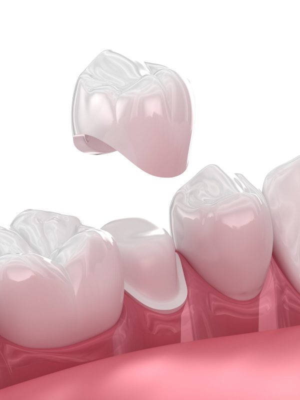 Dental crown placement over tooth. 3D illustration