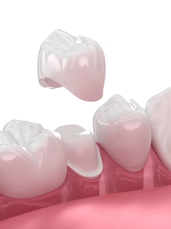 Dental crown placement over tooth. 3D illustration
