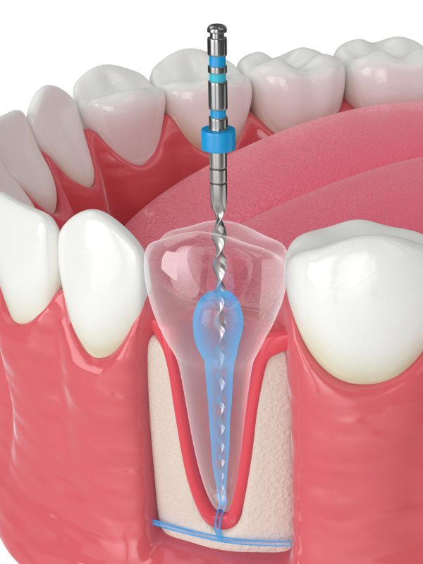 3d render of lower jaw with endodontic rotary file over white background. Endodontic treatment concept.