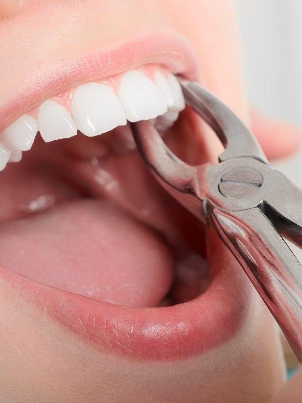 Removing the sick tooth from girls mouth